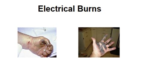 electrical burns are similar to what other burn